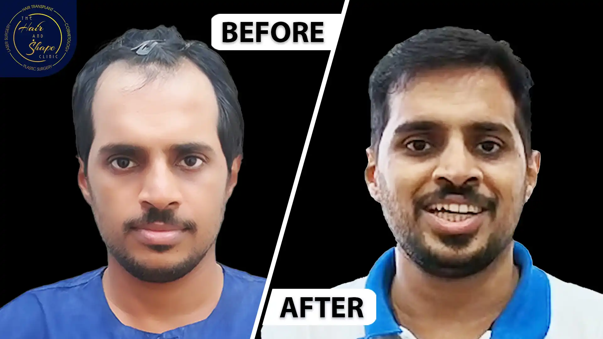 Hair Transplant result9